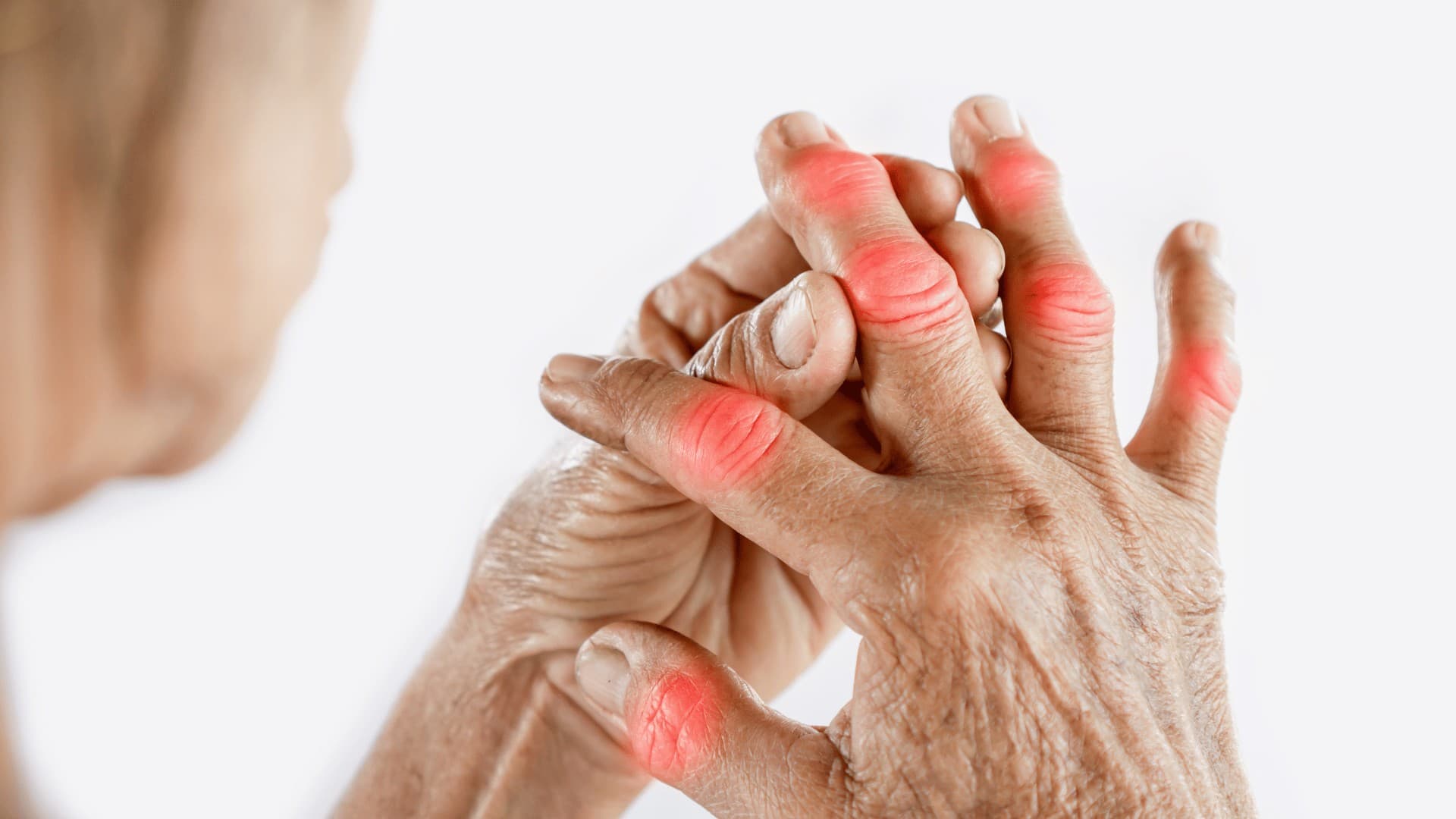 Arthrose beginnt oft lange vor den ersten starken Schmerzen