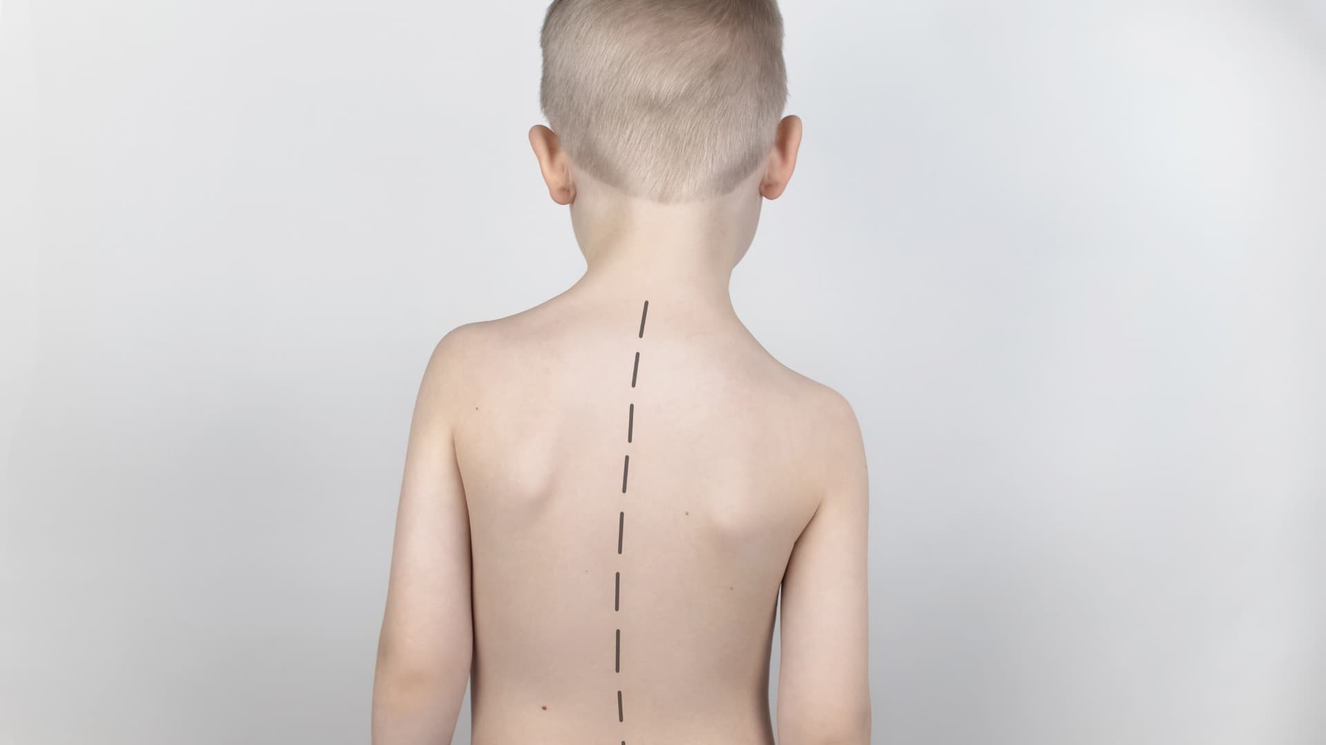 Skoliose bei Kindern und Jugendlichen: Die Wirbelsäule verändert sich in drei Dimensionen